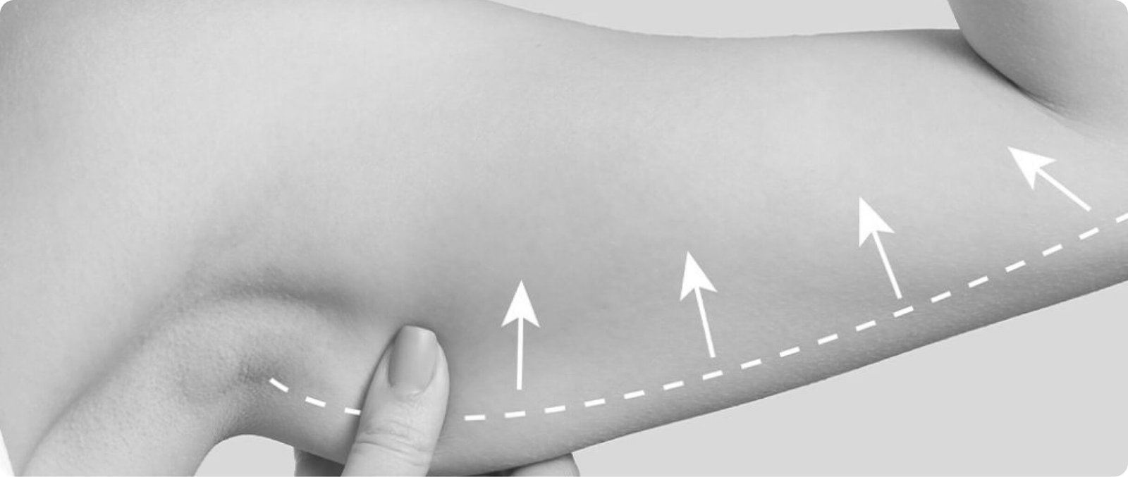 Arm lift brachioplasty