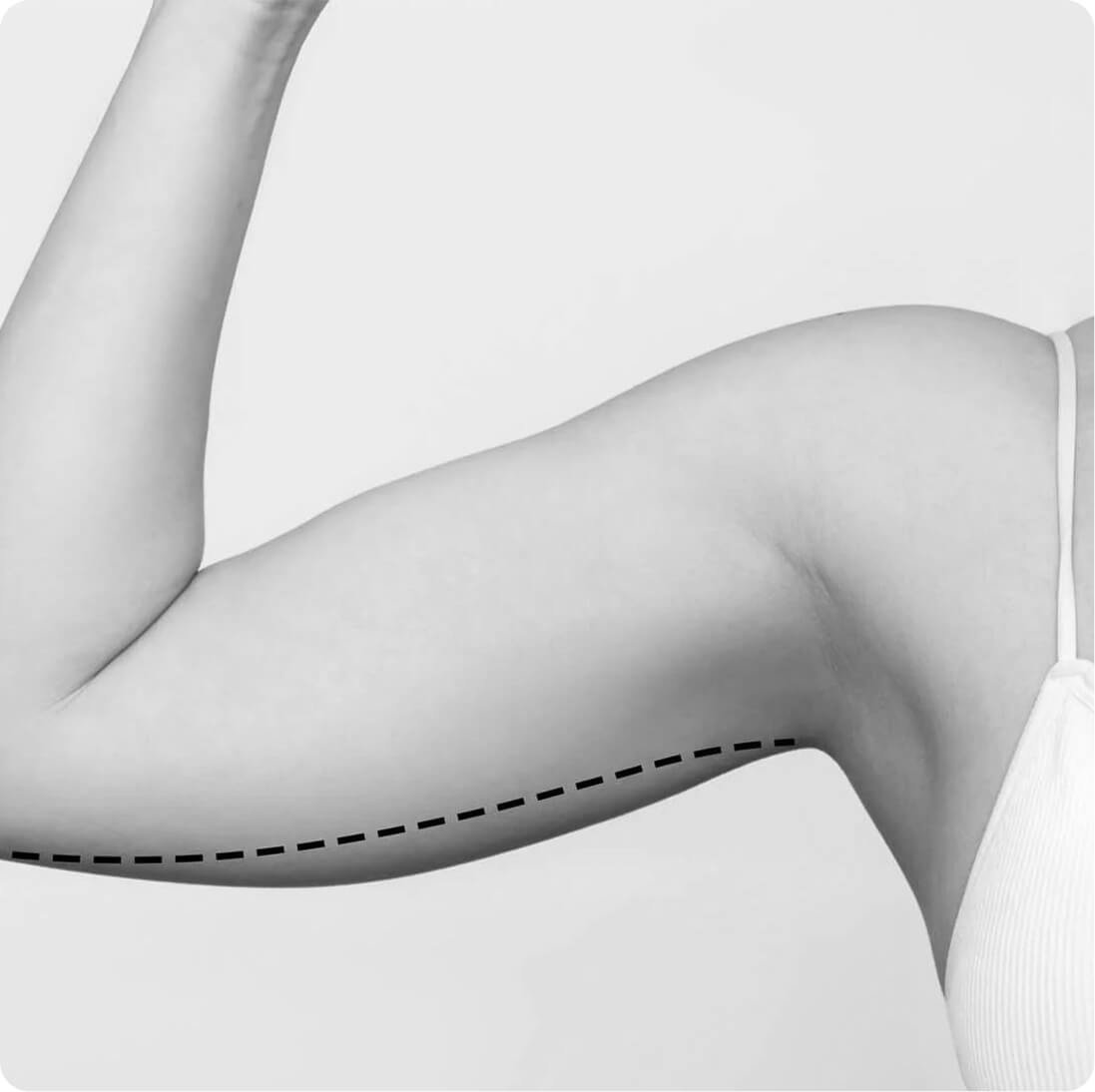 Arm lift result