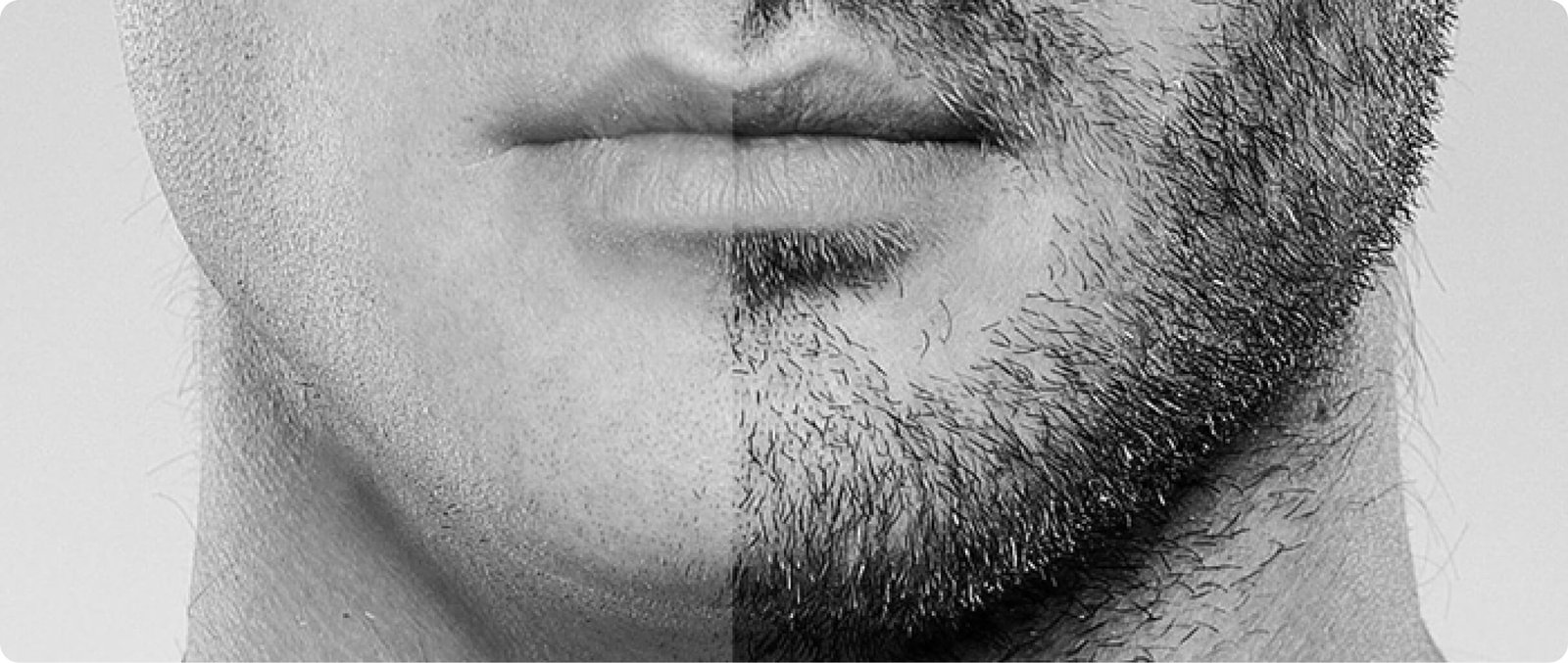 Beard and mustache transplantation