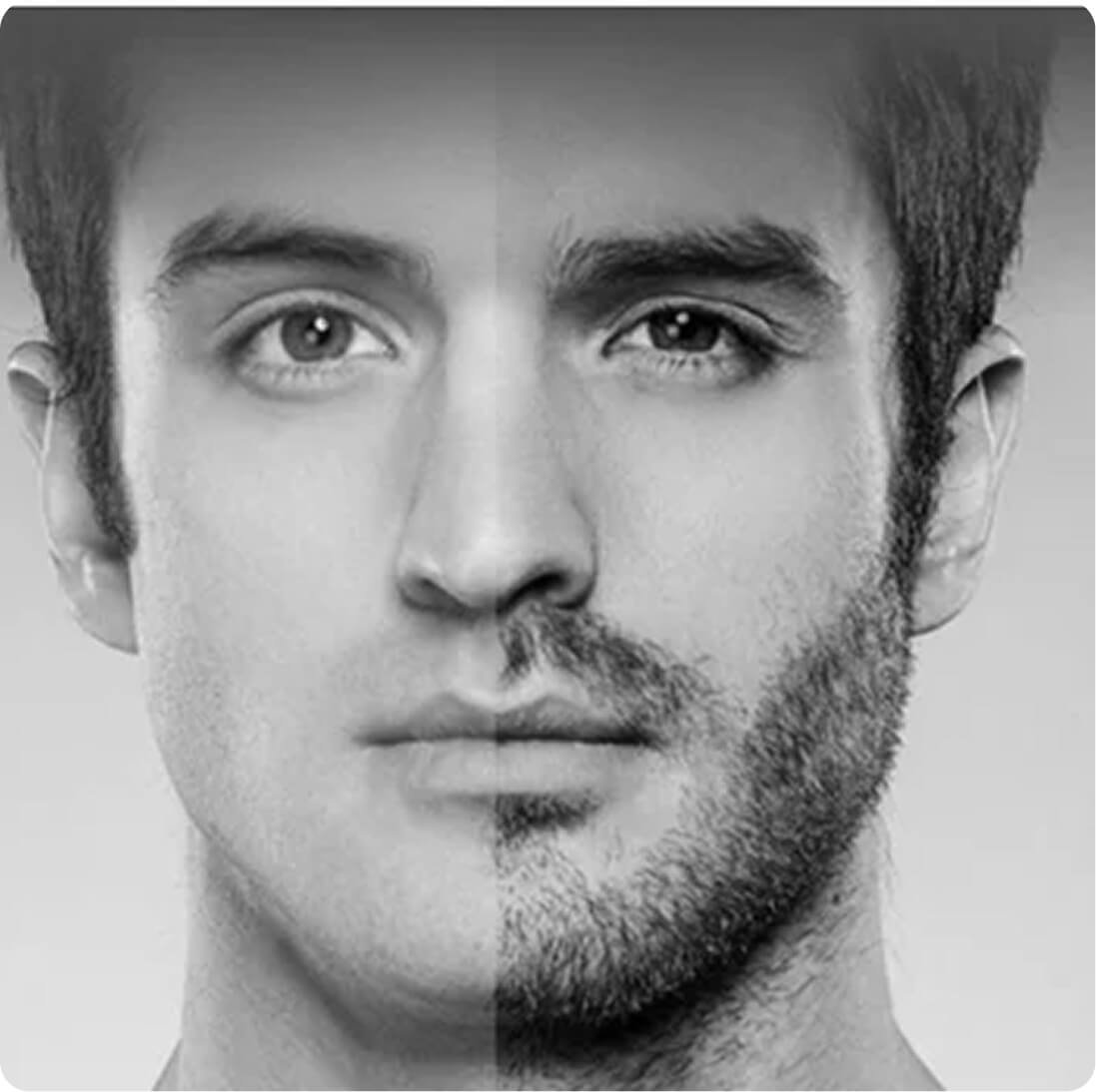 Beard transplant result