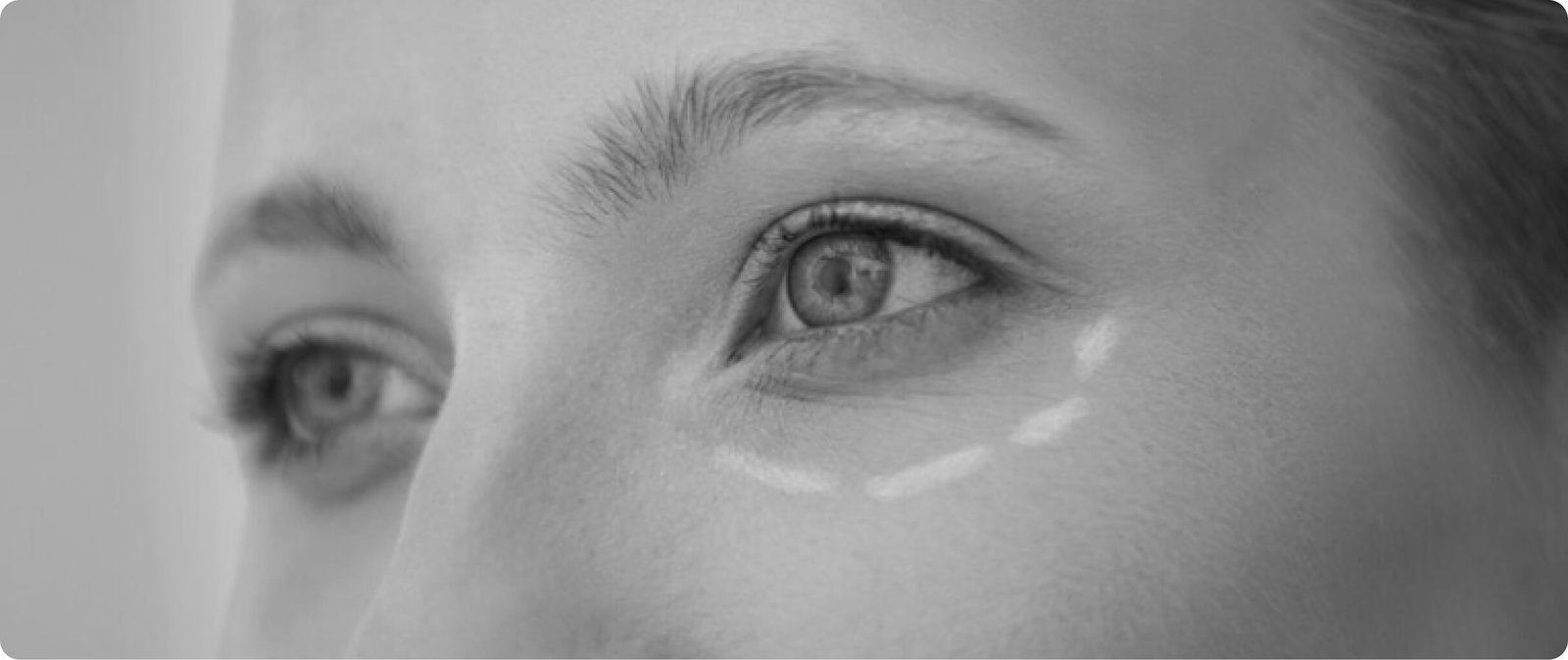 Blepharoplasty eyelid surgery