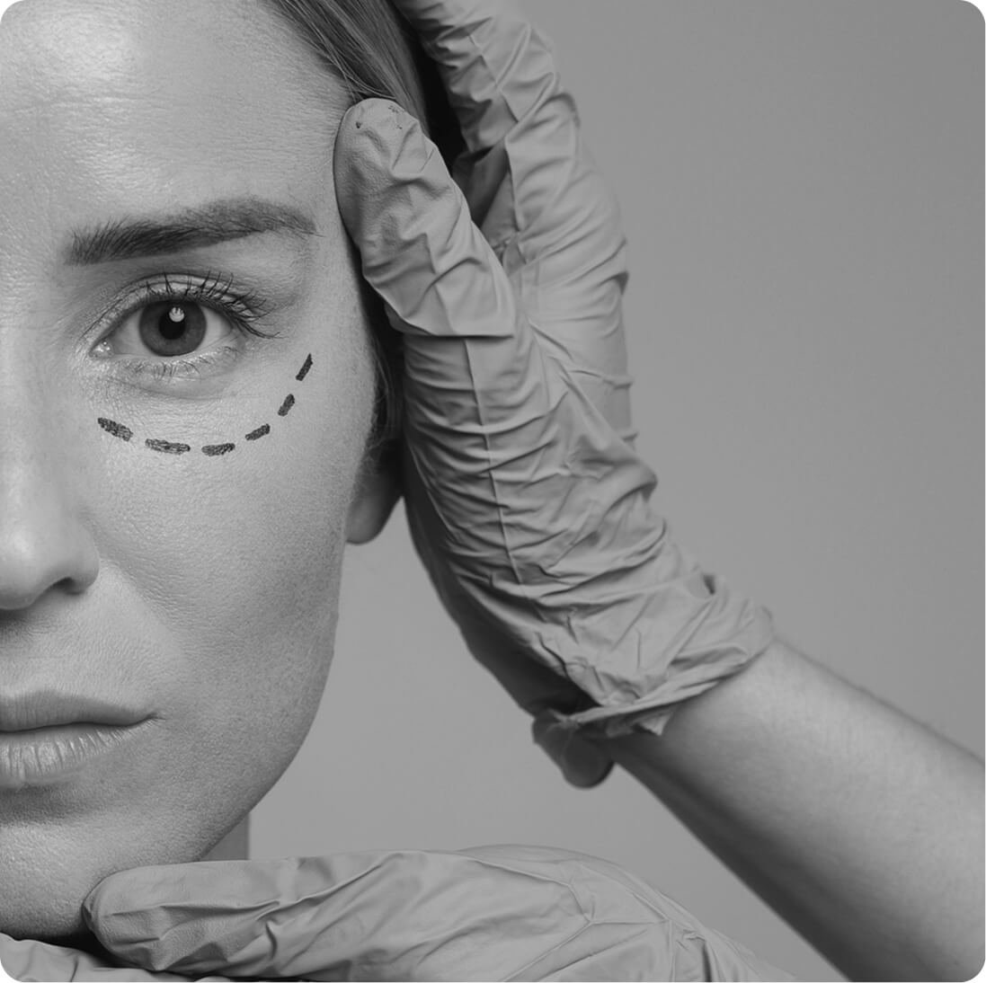 Blepharoplasty result