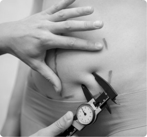Liposuction