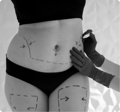 Tummy tuck