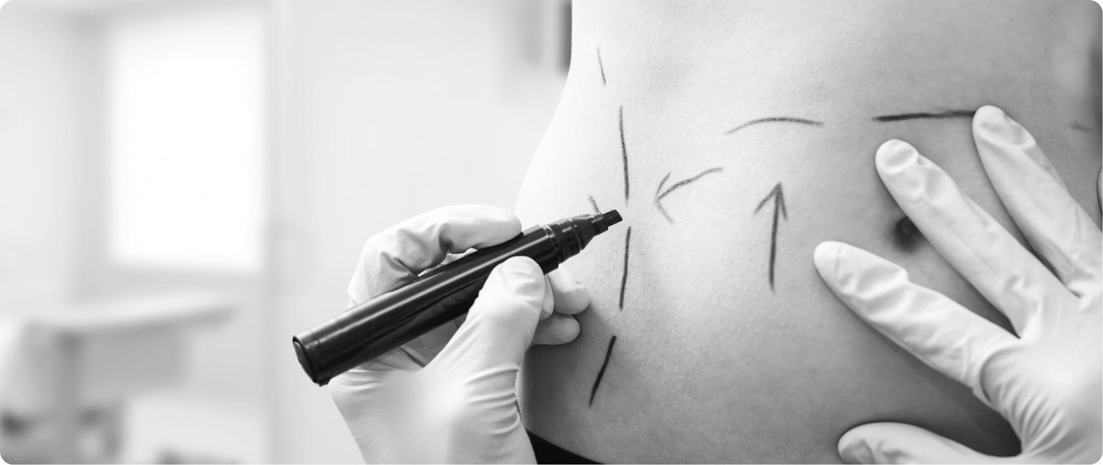 Body contouring for gender affirmation