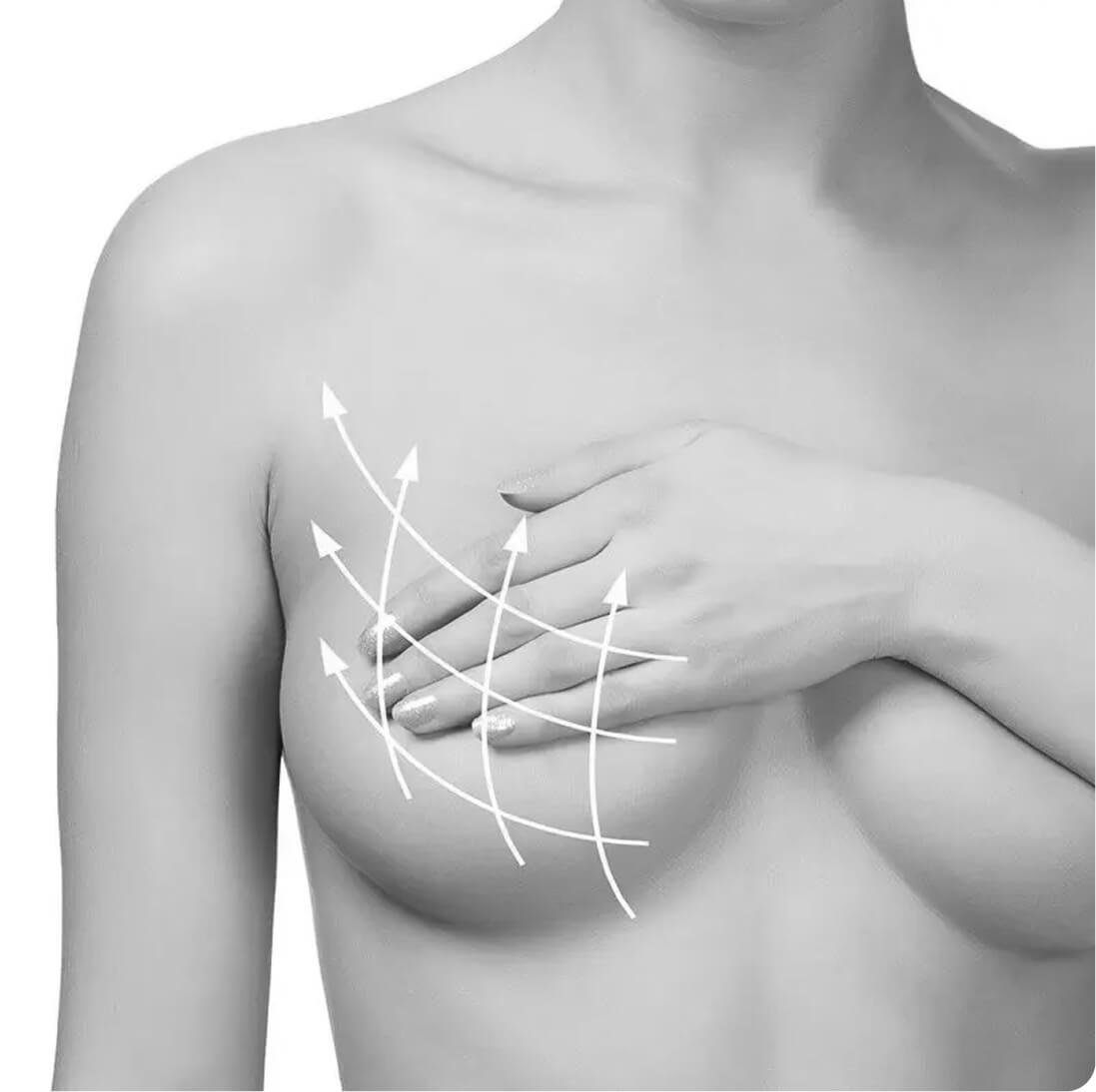 Breast lift result