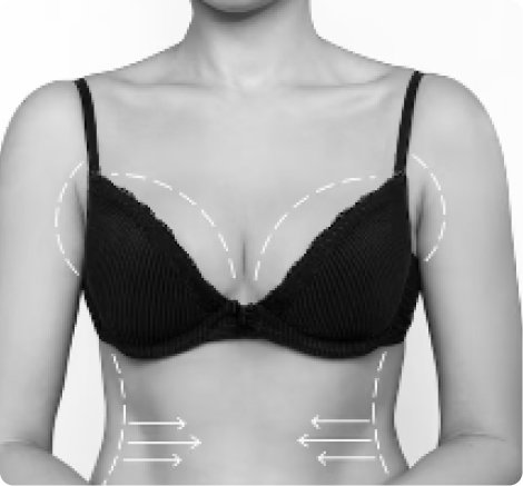 Breast augmentation