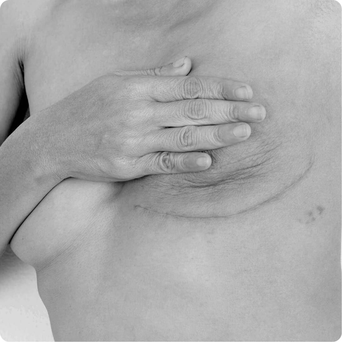 Breast reconstruction result