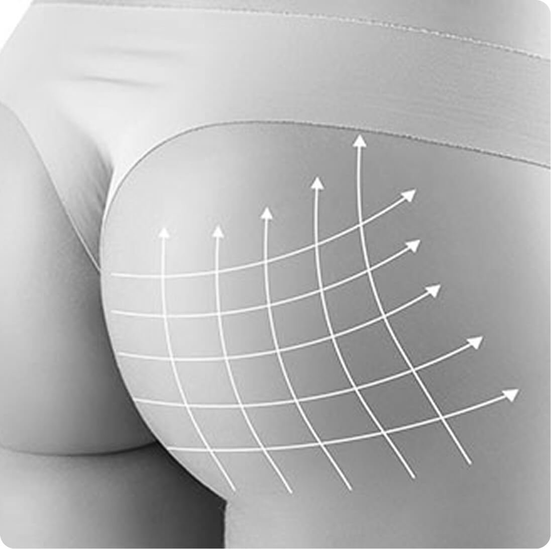 Buttock augmentation result