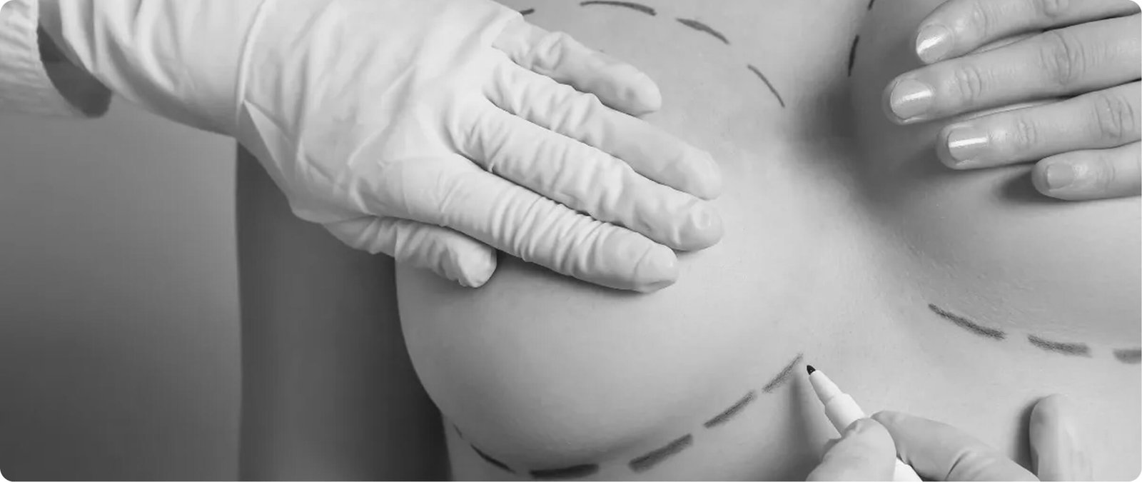 Chest gender affirmation surgeries