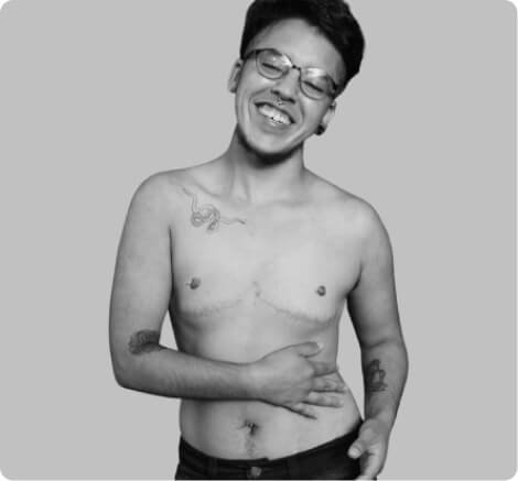 Mastectomy with chest contouring for transgender men