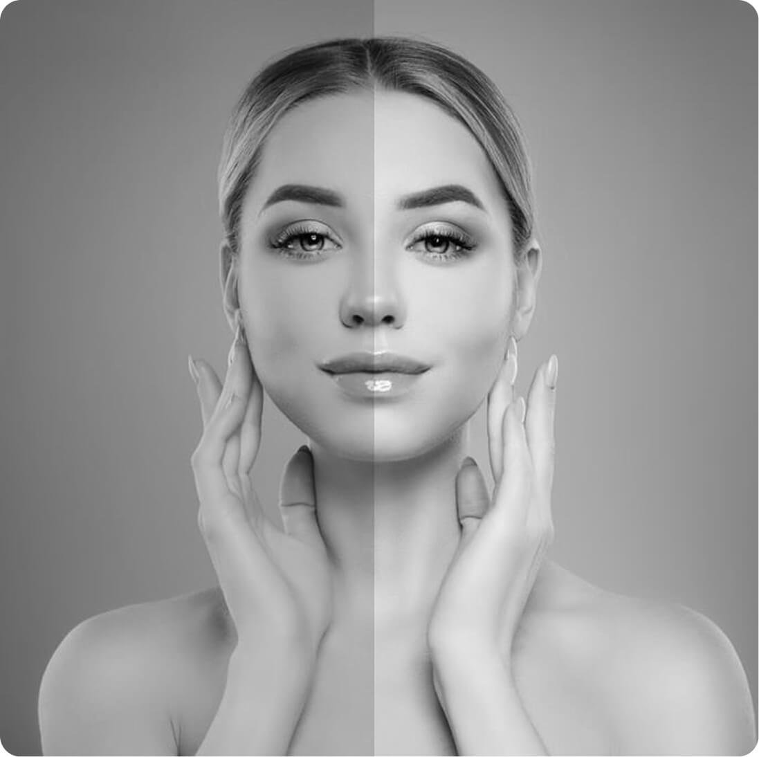 Chin and cheek augmentation result
