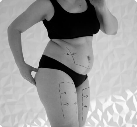 Total body contouring
