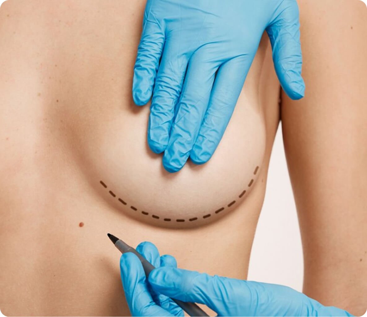 Breast procedures