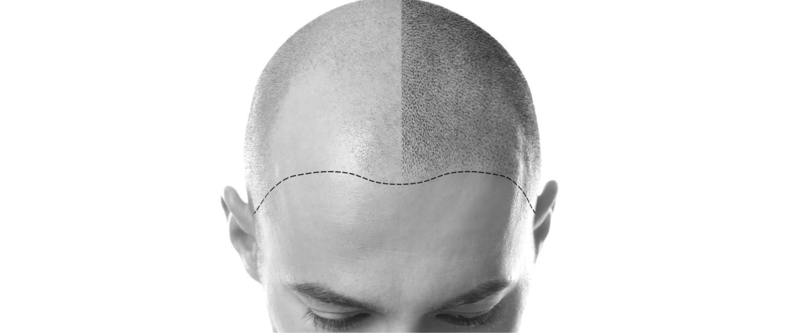 DHI hair transplant in Thailand