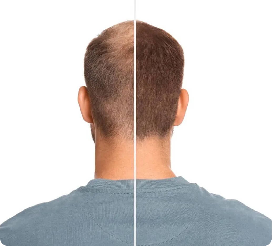 Why DHI hair transplant in Thailand