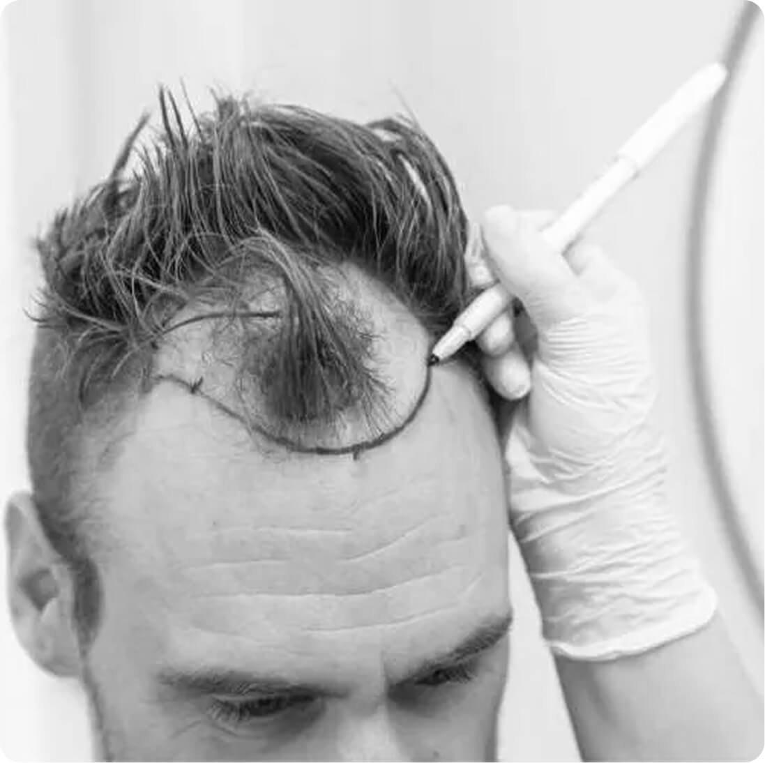 DHI hair transplant result