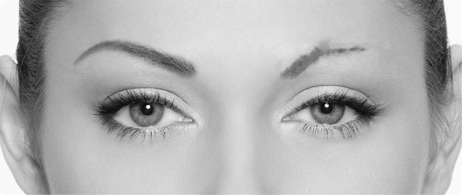 Eyebrow transplantation in Thailand