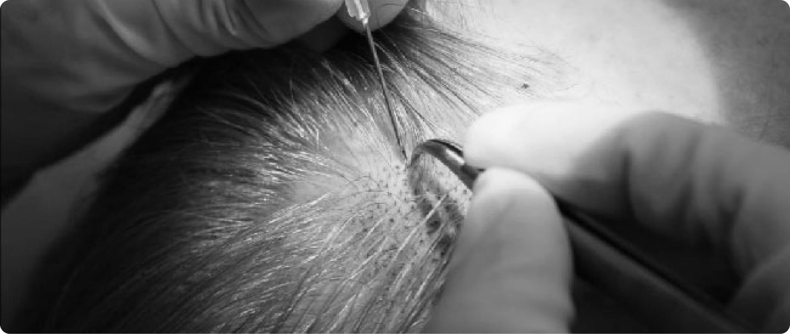 FUE hair transplant in Thailand