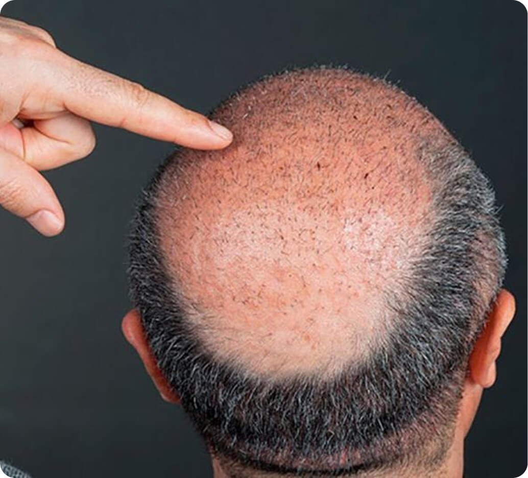 Why FUE hair transplant in Thailand