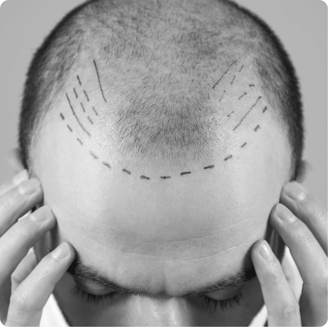 FUE hair transplant result