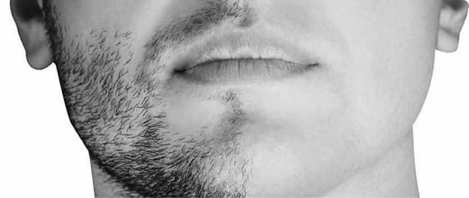 Facial hair restoration in Thailand