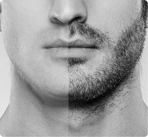 Beard and mustache transplantation