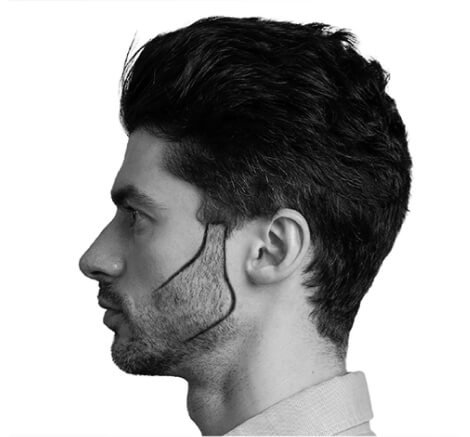 Sideburn restoration