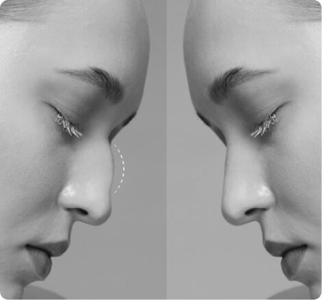Rhinoplasty
