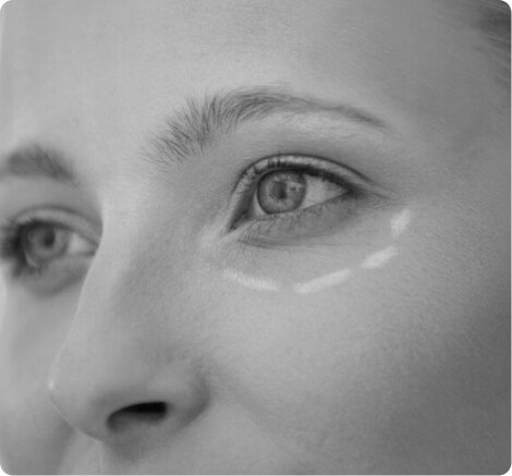 Blepharoplasty
