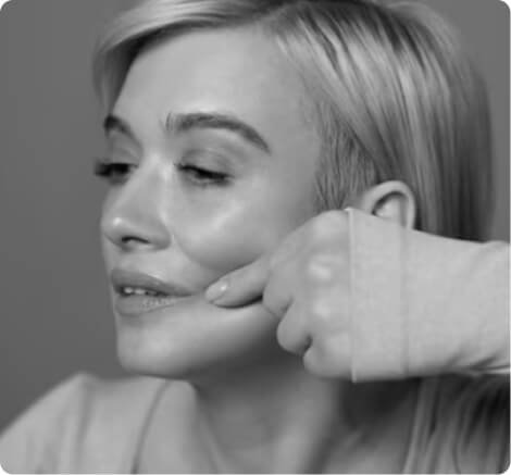 Facelift and neck lift
