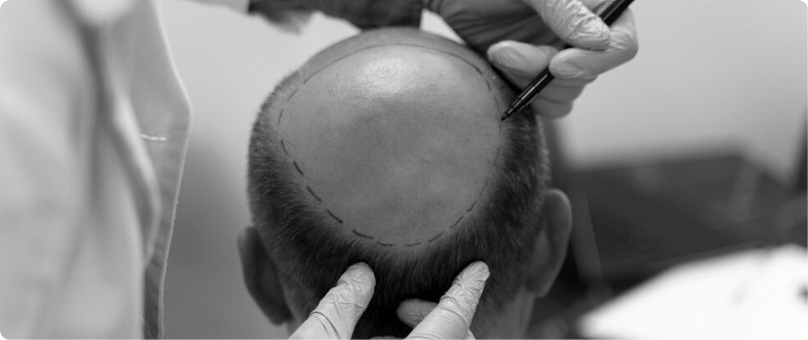 Hair transplantation in Thailand