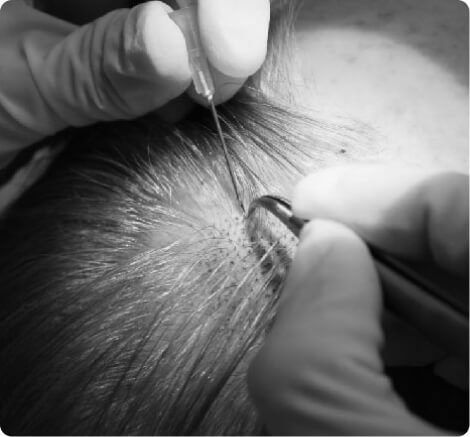 Follicular unit extraction (FUE)