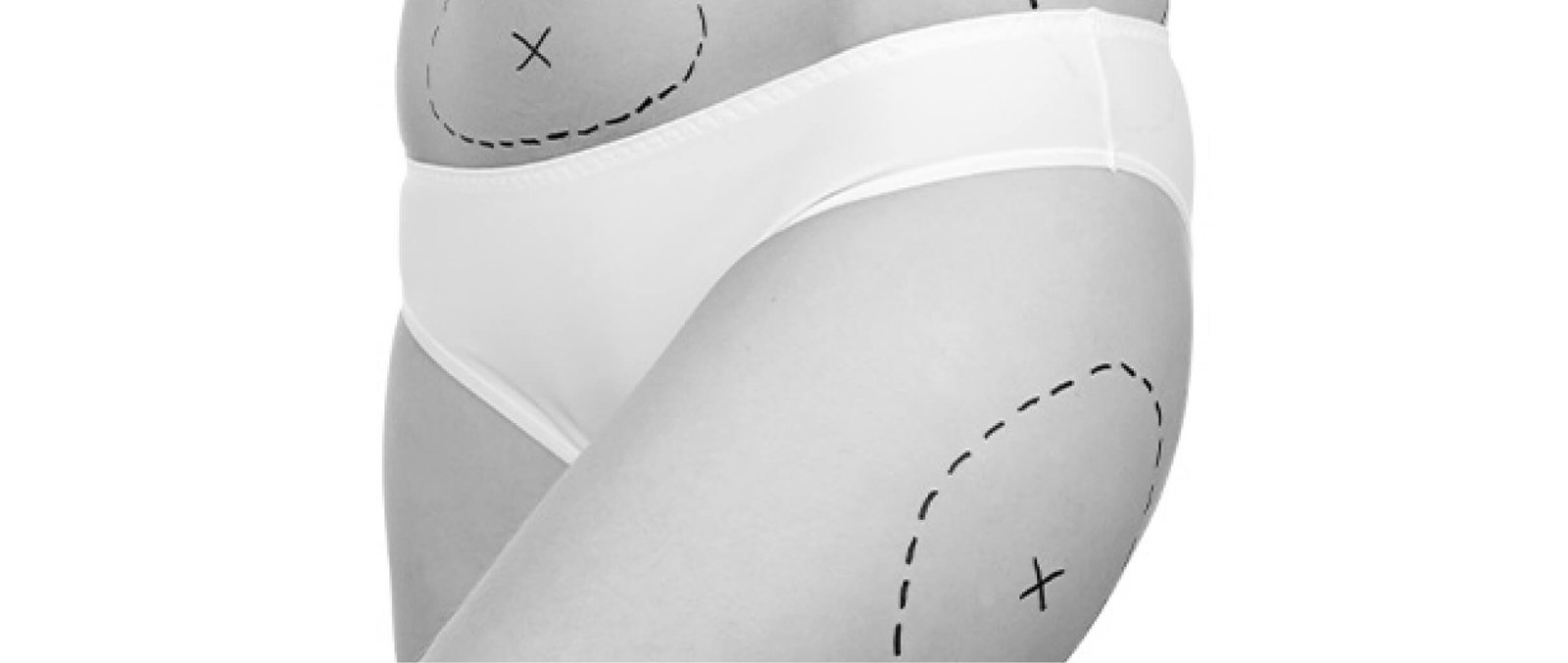 Hip augmentation or reduction in Thailand