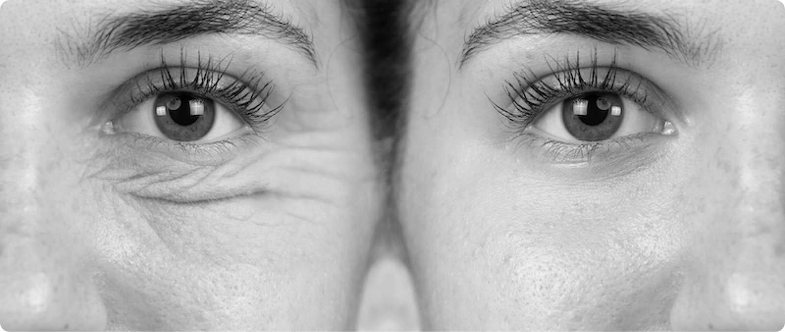 Laser skin resurfacing