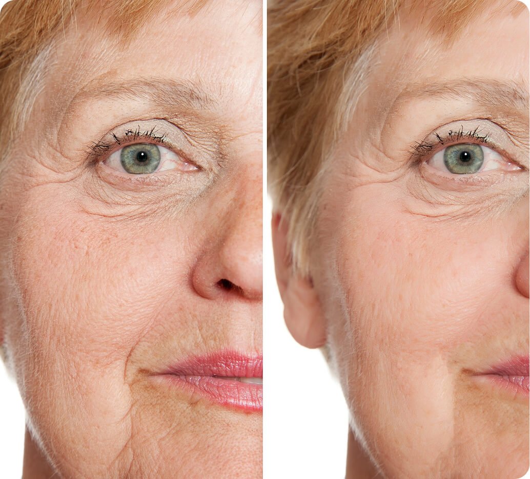 Why laser skin resurfacing in Thailand