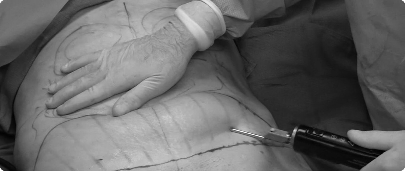 Liposuction