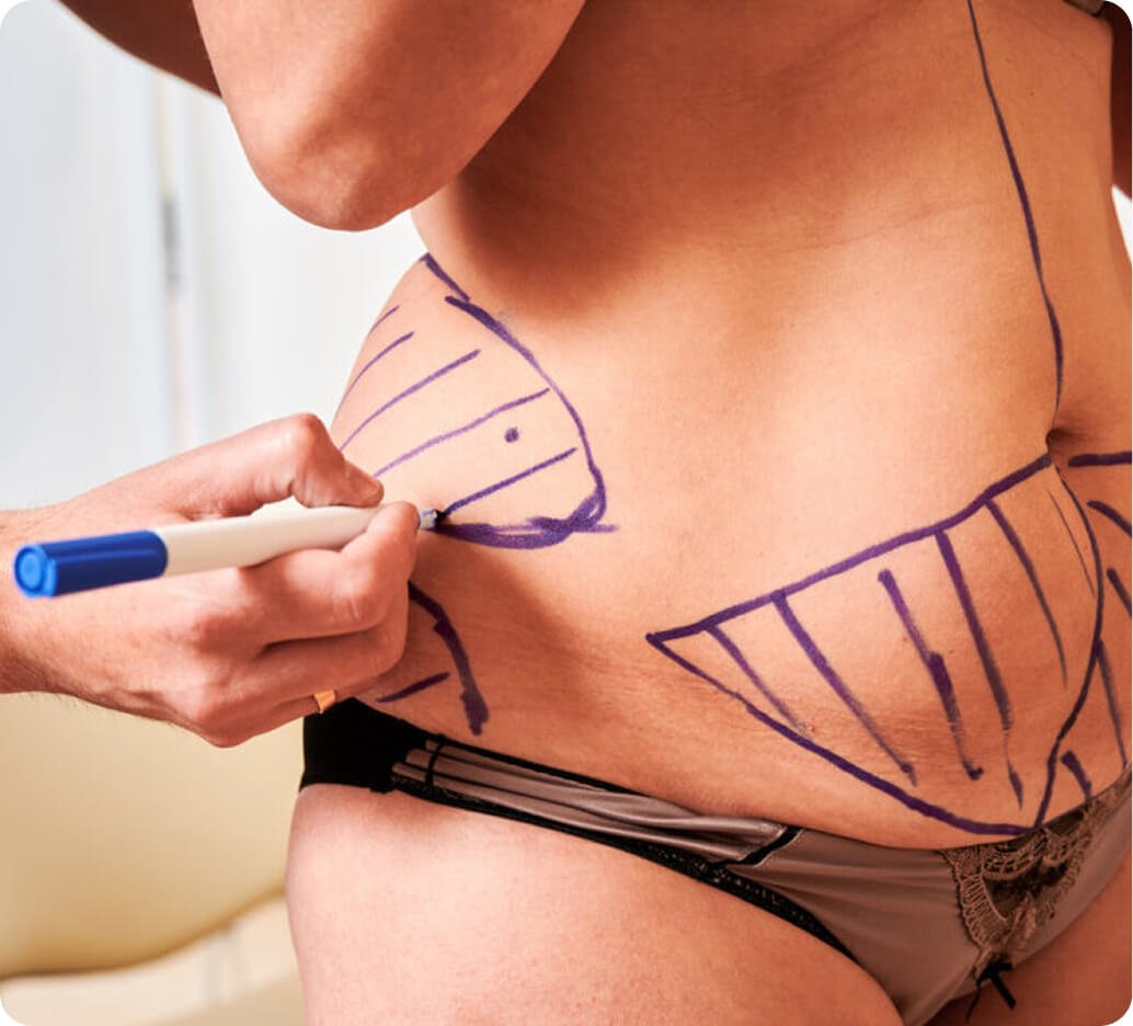 Why liposuction in Thailand