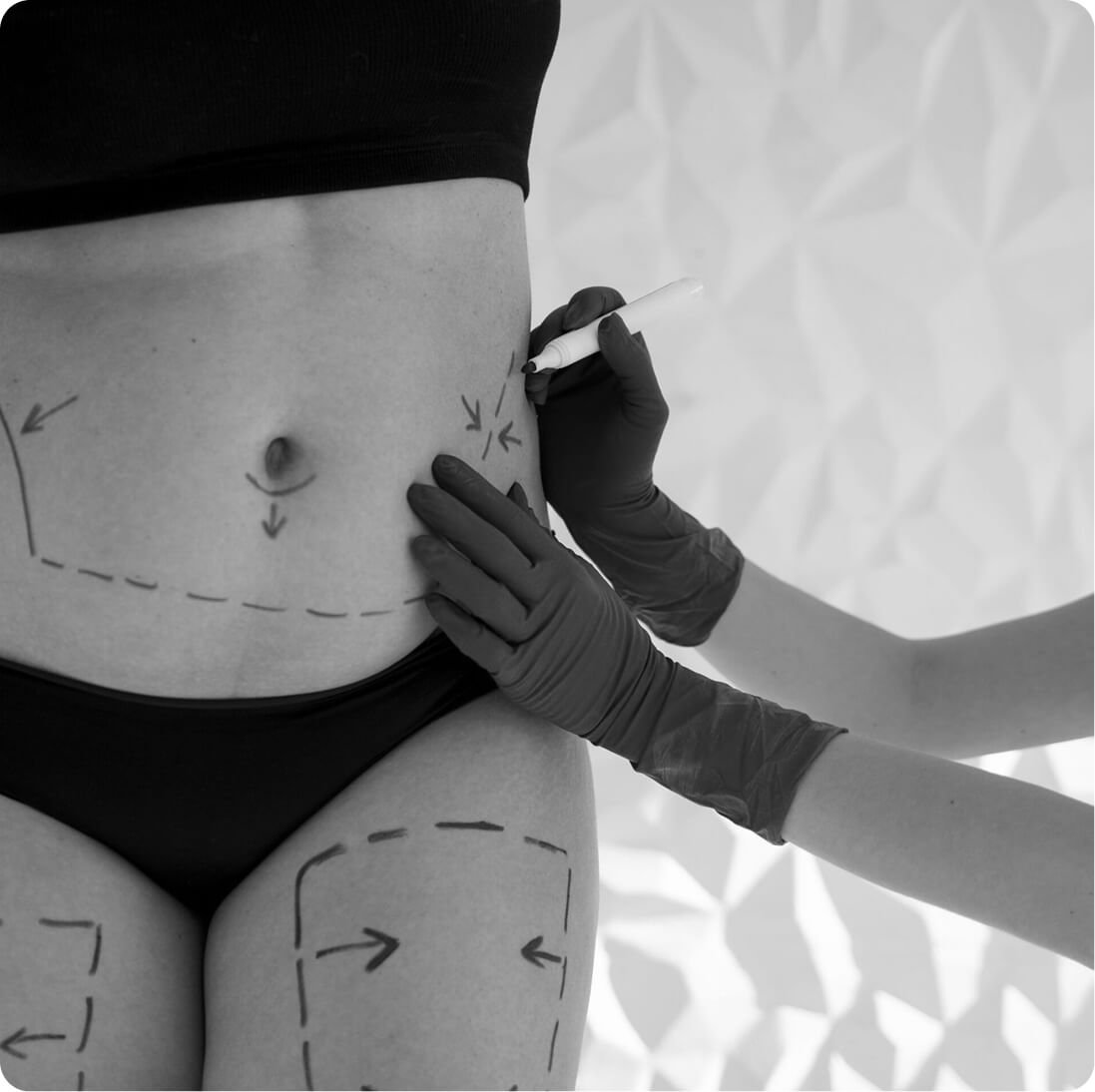 Liposuction result
