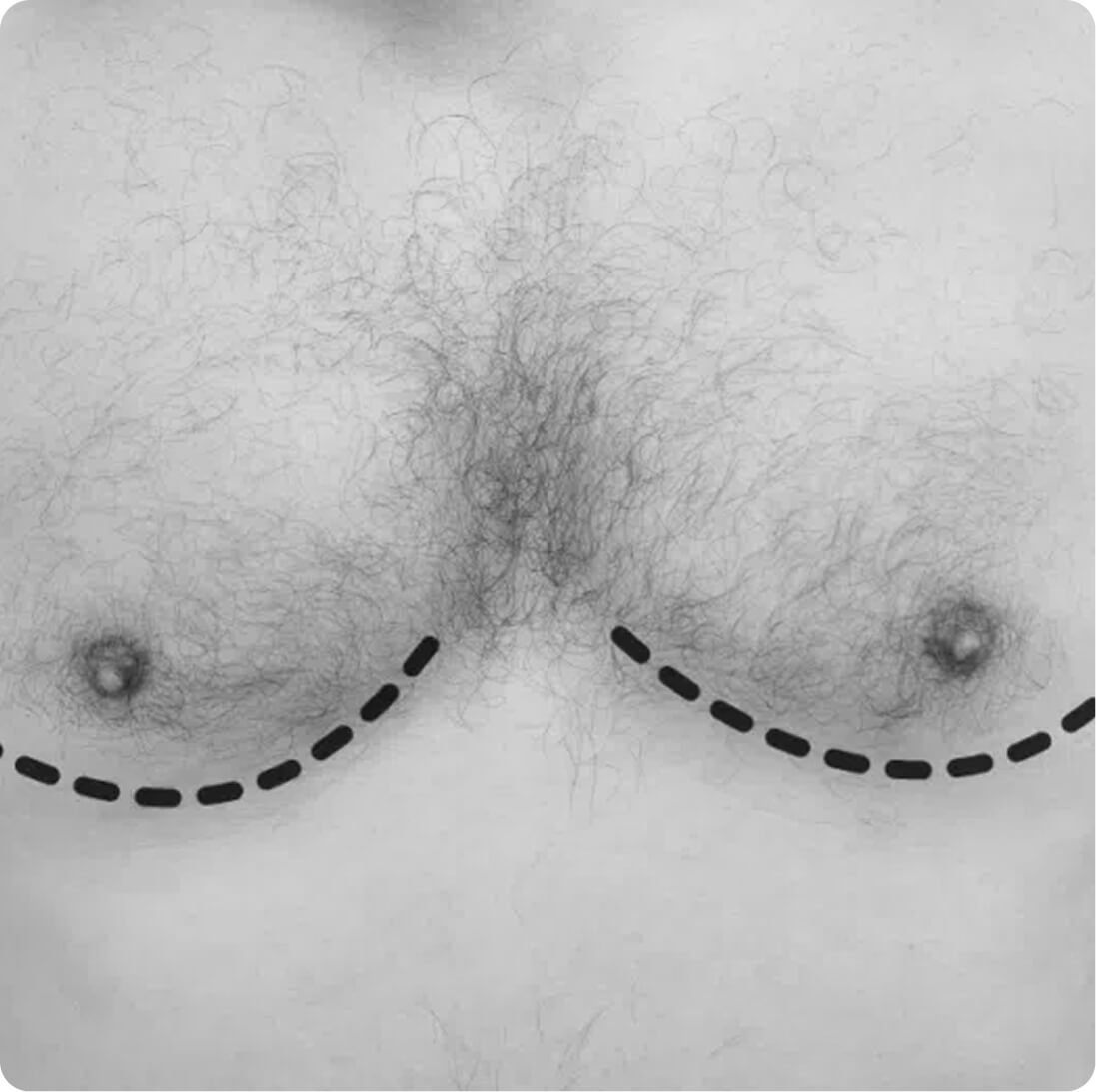 Male breast reduction result