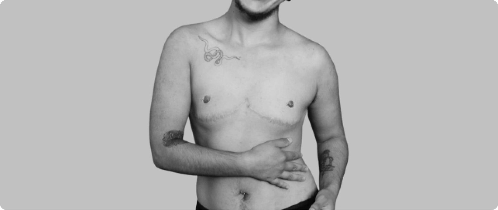 Mastectomy with chest contouring