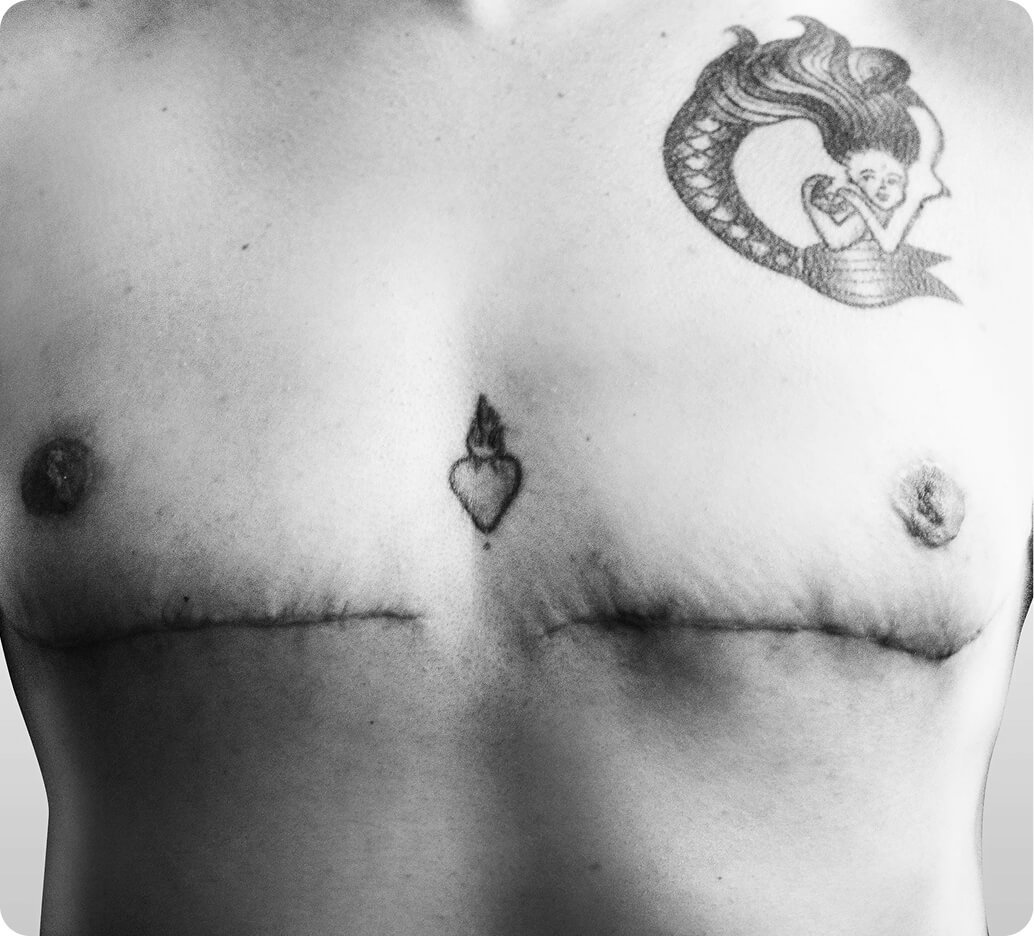 Why mastectomy with chest contouring in Thailand