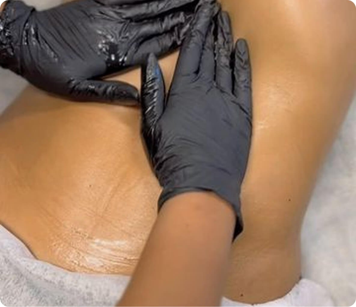 Laser hair removal