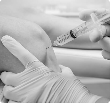 PRP hair restoration