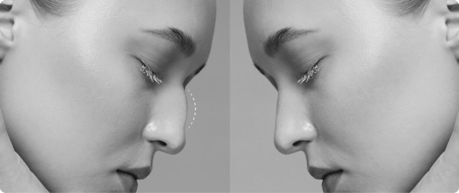 Rhinoplasty nose reshaping
