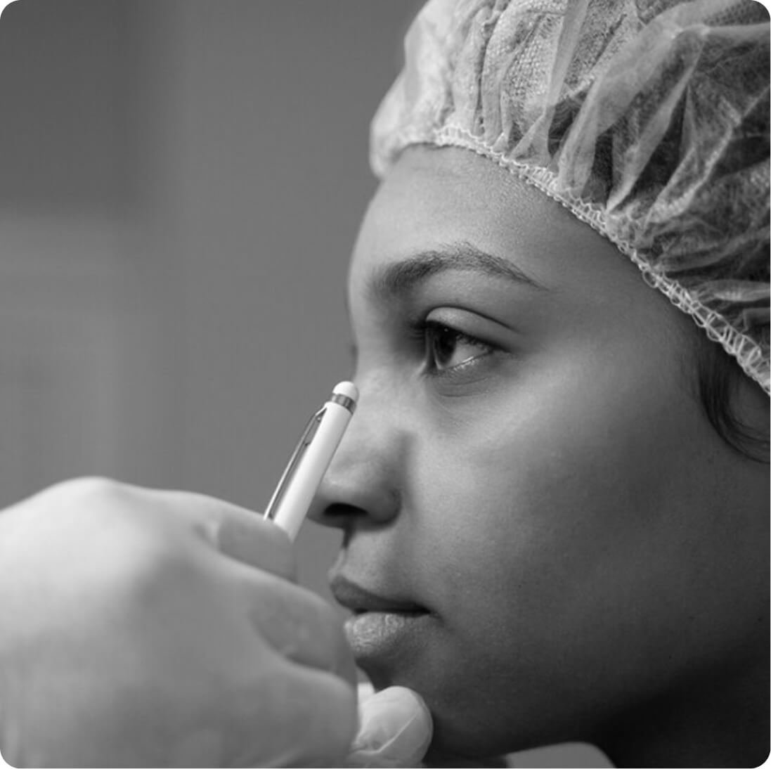 Rhinoplasty result