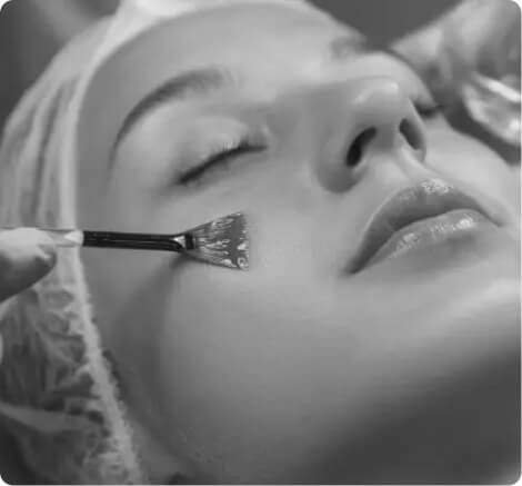 Chemical peels
