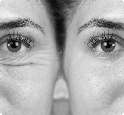 Laser skin resurfacing