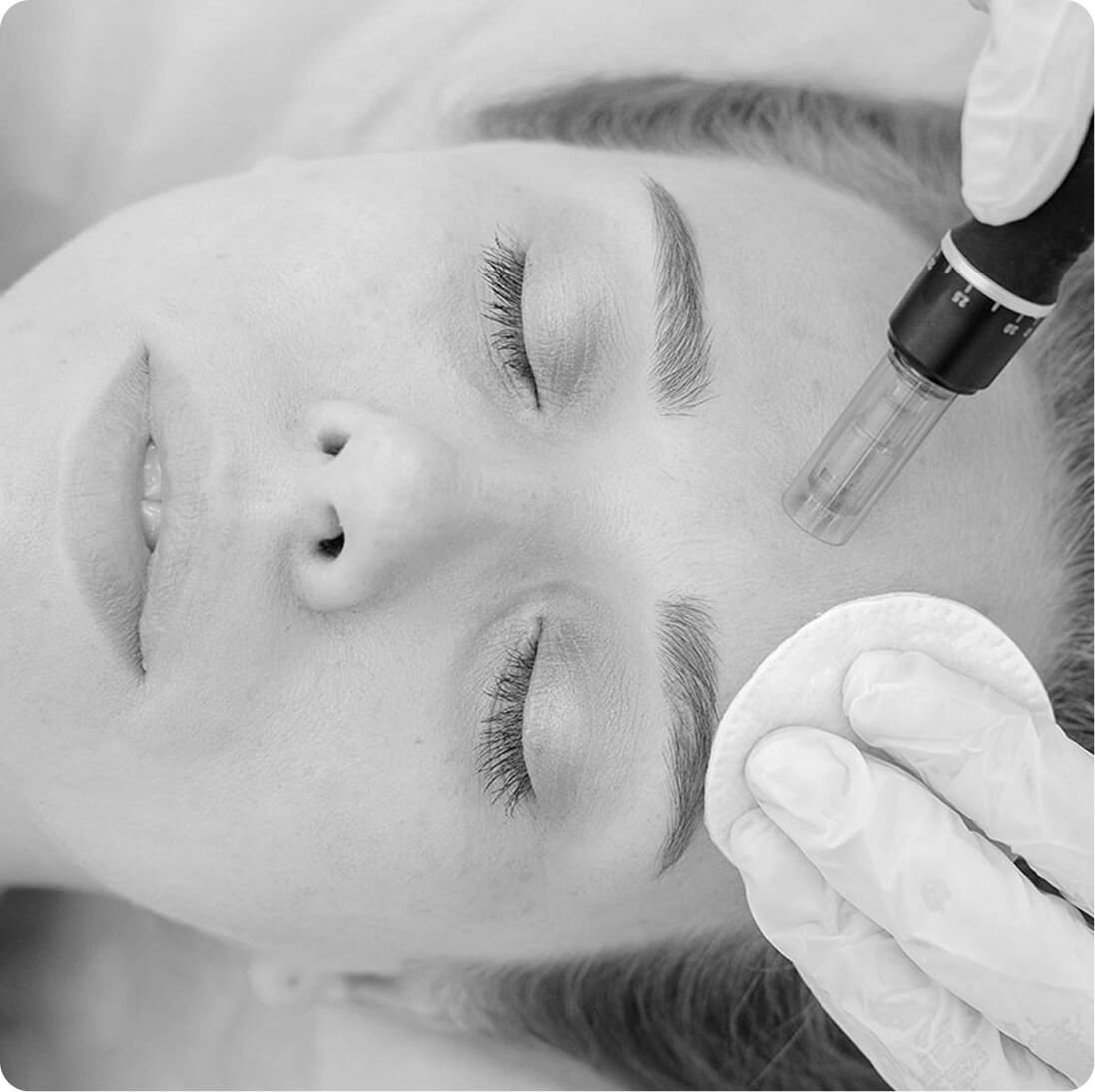 Stem cell facelift result