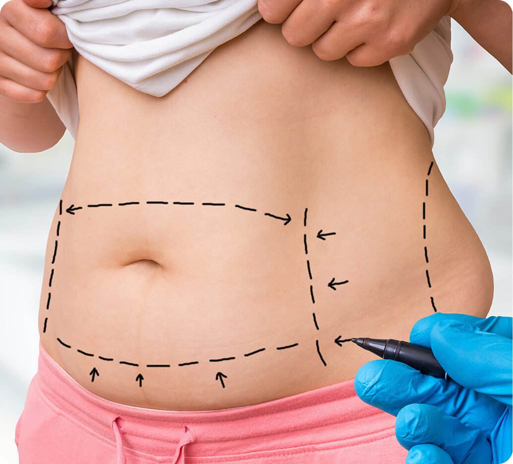 Why targeted liposuction in Thailand